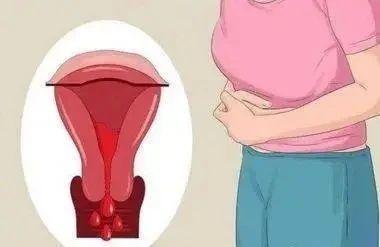 阴道不规则出血有哪些原因？