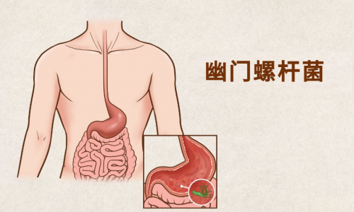 什么是幽门螺旋杆菌？