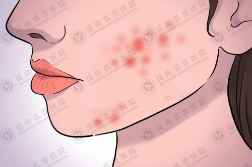 为什么天热了，痘痘出的多了？