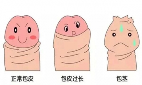 包茎有哪些影响？包皮过长割不割？