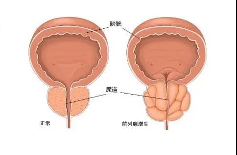 【昆山医院】前列腺增生会发展成前列腺癌吗？筛查前列腺癌的指标是什么？.jpg