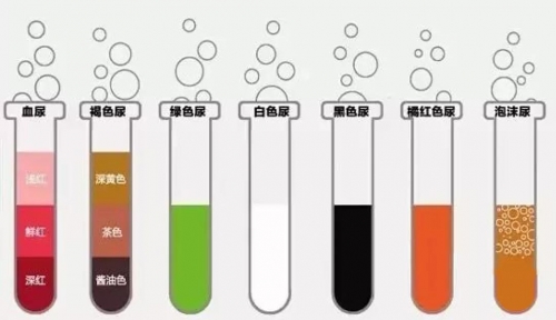 【昆山医院】“尿液颜色”透露你的健康，如果是这几种，那你的身体可能出问题了！