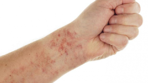 冬季来临！这7种常见皮肤问题防护攻略请收好！